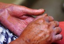 Detectan primer caso de Lepra en Chile en la ciudad de Valdivia