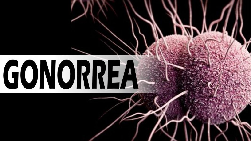 gonorrea