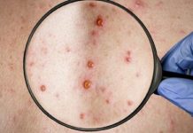 Coordinan centros de salud para atender casos sospechosos de virus del mono en Los Lagos