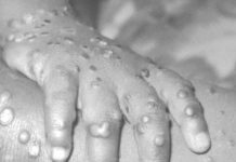 Ministerio de Salud confirma 39 casos de viruela del mono en el país