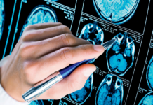 Hospital Regional atiende a 480 niños con epilepsia al año