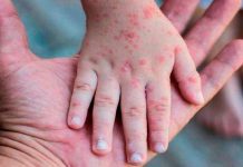 ISP estudia caso sospechoso de viruela del mono en Calbuco