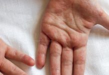 Confirman cinco casos de escarlatina en Talca: ¿En qué consiste esta enfermedad y cómo se contagia?