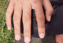 Confirman brote de sarna en un colegio chilote y de coqueluche en una escuela de Llanquihue