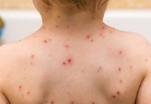 Salud advierte de complicaciones asociadas a varicela e insta a fortalecer higiene y protección en establecimientos