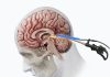 Hospital de Puerto Montt presenta técnica neuroquirúrgica única en Chile ante congreso mundial