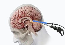 Hospital de Puerto Montt presenta técnica neuroquirúrgica única en Chile ante congreso mundial