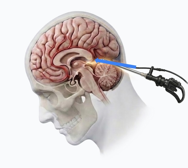Imagen de Referencia de Procedimiento Endoscópico Cerebral